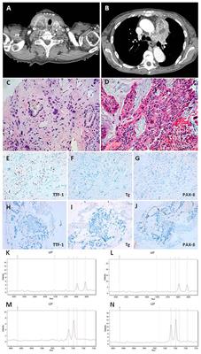 The Molecular Signature More Than the Site of Localization Defines the Origin of the Malignancy